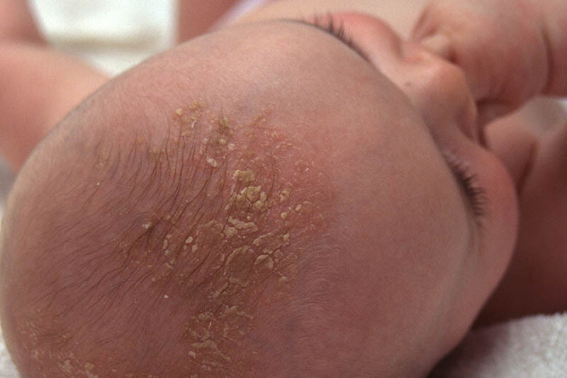 Cradle Cap